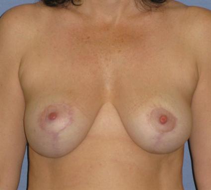 Breast Reduction Before & After Patient #1414