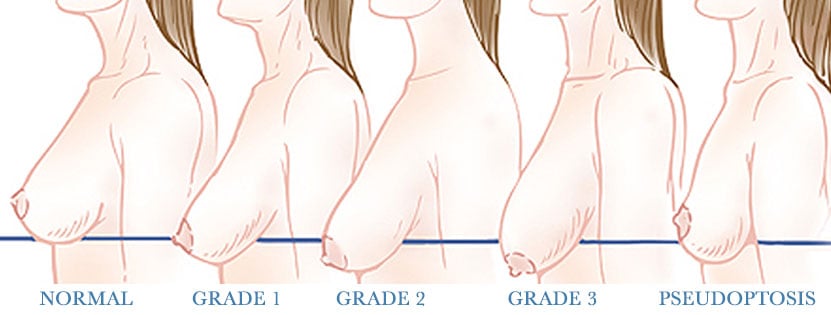 breast-ptosis-grades