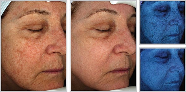 halo-laser-cosmetic-procedure-results