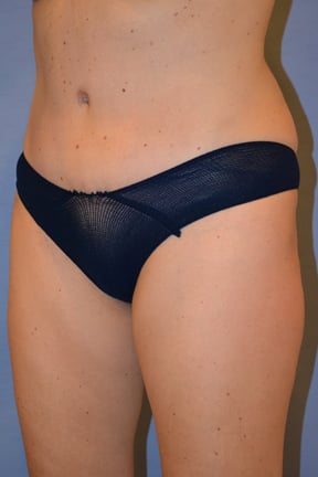 Tummy Tuck Before & After Patient #3582