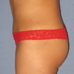 Tummy Tuck Before & After Patient #3596