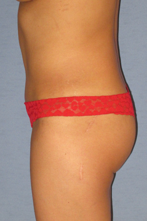 Tummy Tuck Before & After Patient #3596