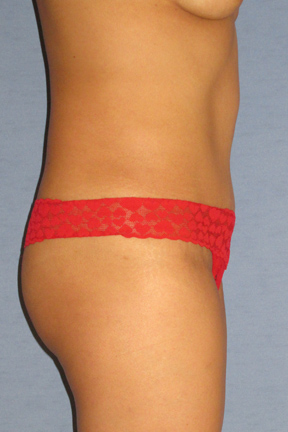 Tummy Tuck Before & After Patient #3596