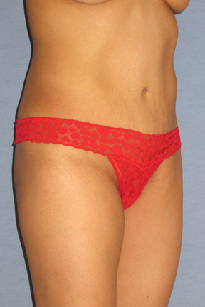 Tummy Tuck Before & After Patient #3596