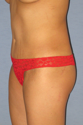 Tummy Tuck Before & After Patient #3596