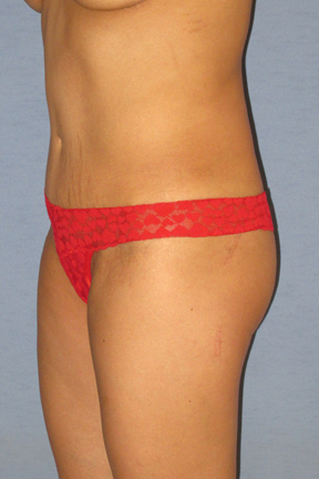 Tummy Tuck Before & After Patient #3596