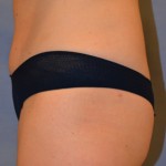 Tummy Tuck Before & After Patient #3582