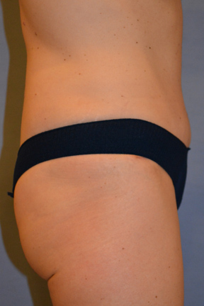 Tummy Tuck Before & After Patient #3582