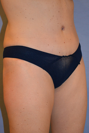 Tummy Tuck Before & After Patient #3582