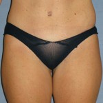 Tummy Tuck Before & After Patient #3591