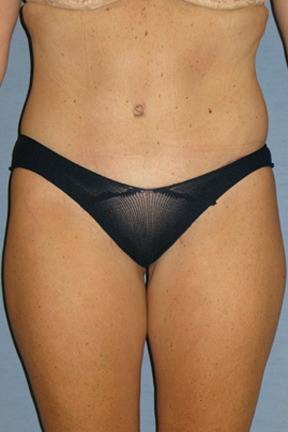 Tummy Tuck Before & After Patient #3591