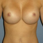 Breast Augmentation Before & After Patient #3652