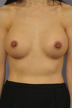 Breast Augmentation Before & After Patient #3832