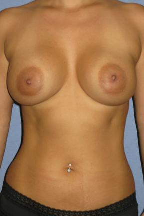 Breast Augmentation Before & After Patient #3835