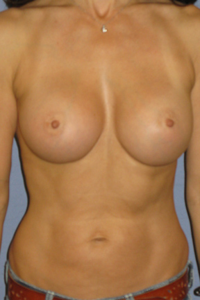 Breast Augmentation Before & After Patient #3842