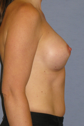 Breast Augmentation Before & After Patient #3863