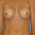 Breast Augmentation Before & After Patient #3868