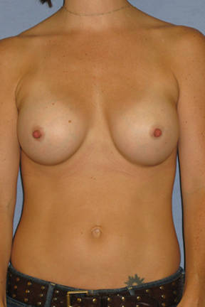 Breast Augmentation Before & After Patient #3868