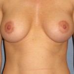 Breast Augmentation Before & After Patient #3896