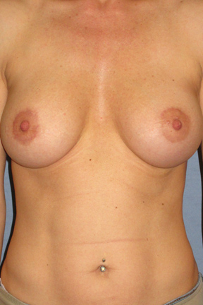 Breast Augmentation Before & After Patient #3896