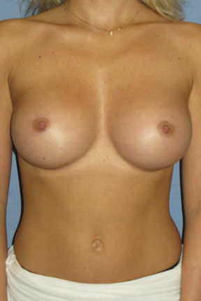 Breast Augmentation Before & After Patient #3663