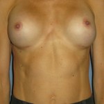 Breast Augmentation Before & After Patient #3628