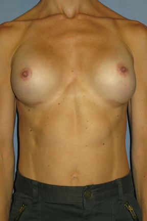 Breast Augmentation Before & After Patient #3628