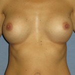 Breast Augmentation Before & After Patient #3674