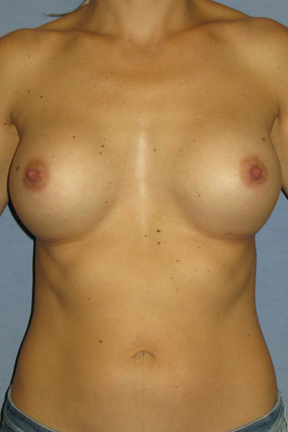 Breast Augmentation Before & After Patient #3674