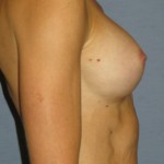 Breast Augmentation Before & After Patient #3697