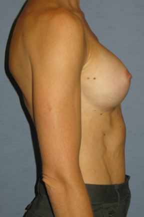 Breast Augmentation Before & After Patient #3628