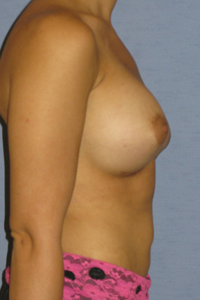 Breast Augmentation Before & After Patient #3715