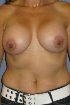 Breast Lift Before & After Patient #4044