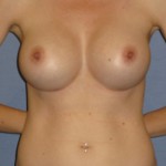 Breast Augmentation Before & After Patient #3738