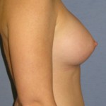 Breast Augmentation Before & After Patient #3752