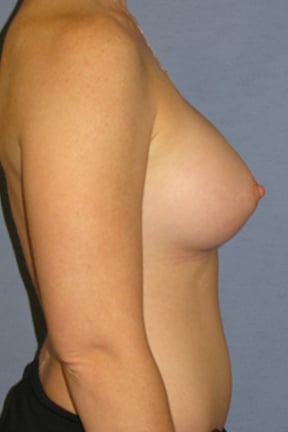 Breast Augmentation Before & After Patient #3752