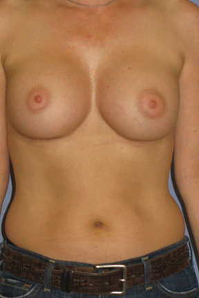 Breast Augmentation Before & After Patient #3775