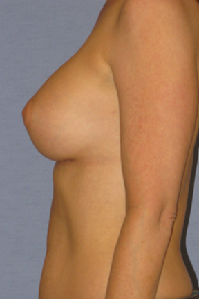 Breast Augmentation Before & After Patient #3775