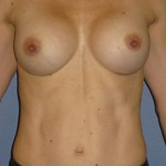 Breast Augmentation Before & After Patient #3785