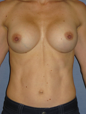 Breast Augmentation Before & After Patient #3785