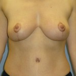 Breast Lift Before & After Patient #3958