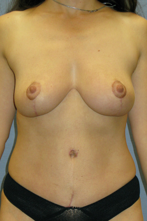 Breast Lift Before & After Patient #3958