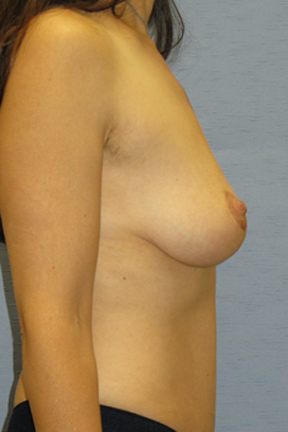 Breast Lift Before & After Patient #3958