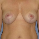 Breast Lift Before & After Patient #3967
