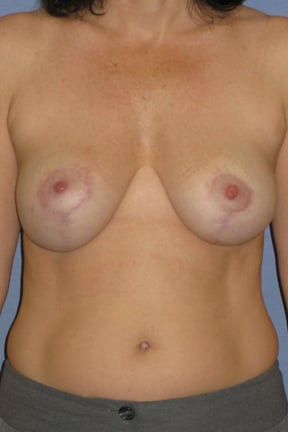 Breast Lift Before & After Patient #3967
