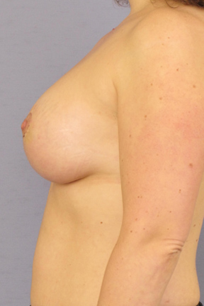 Breast Augmentation Before & After Patient #3977
