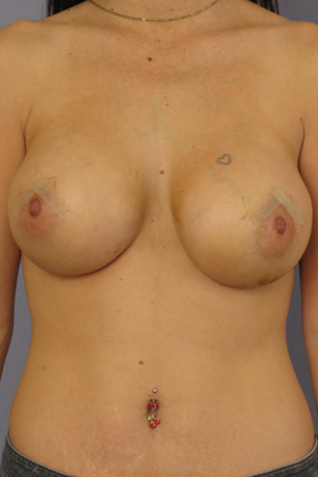 Breast Lift Before & After Patient #3984