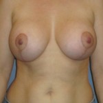 Breast Lift Before & After Patient #3991