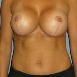 Breast Lift Before & After Patient #4001