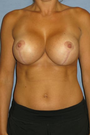 Breast Lift Before & After Patient #4001